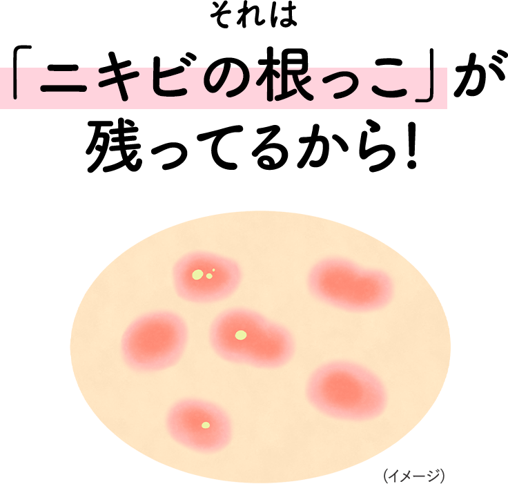 それは「ニキビの根っこ」が残ってるから！