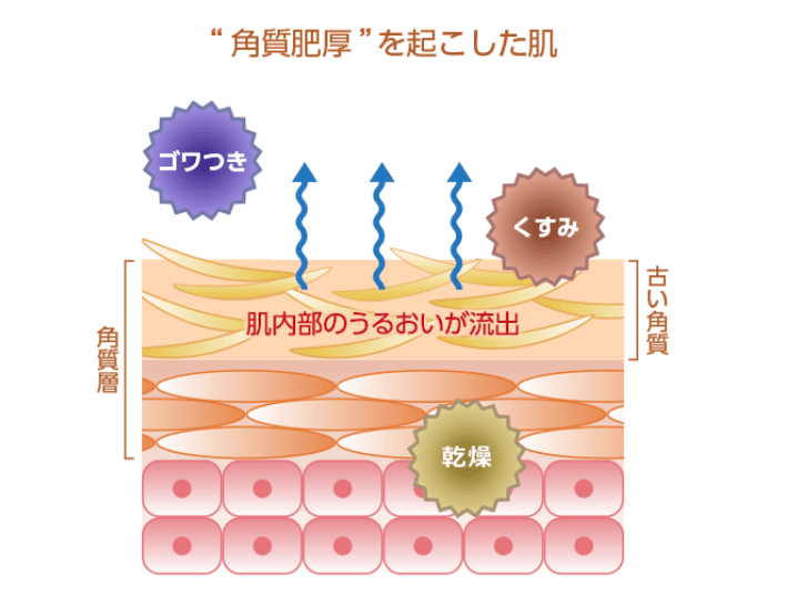 角質肥厚イメージ