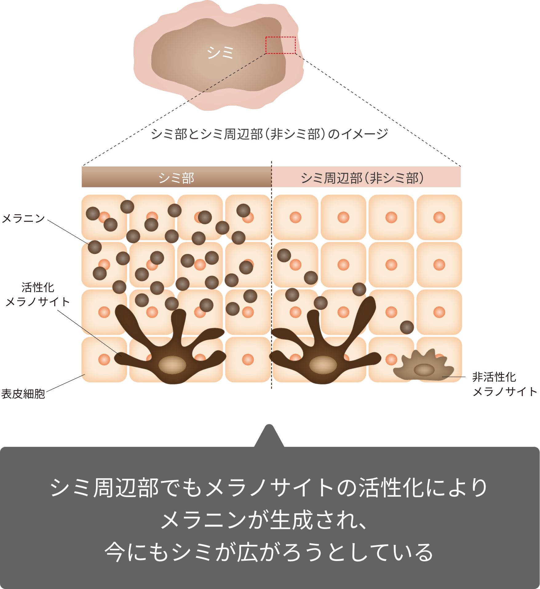 シミ周辺部でもメラノサイトの活性化によりメラニンが生成され、今にもシミが広がろうとしている
