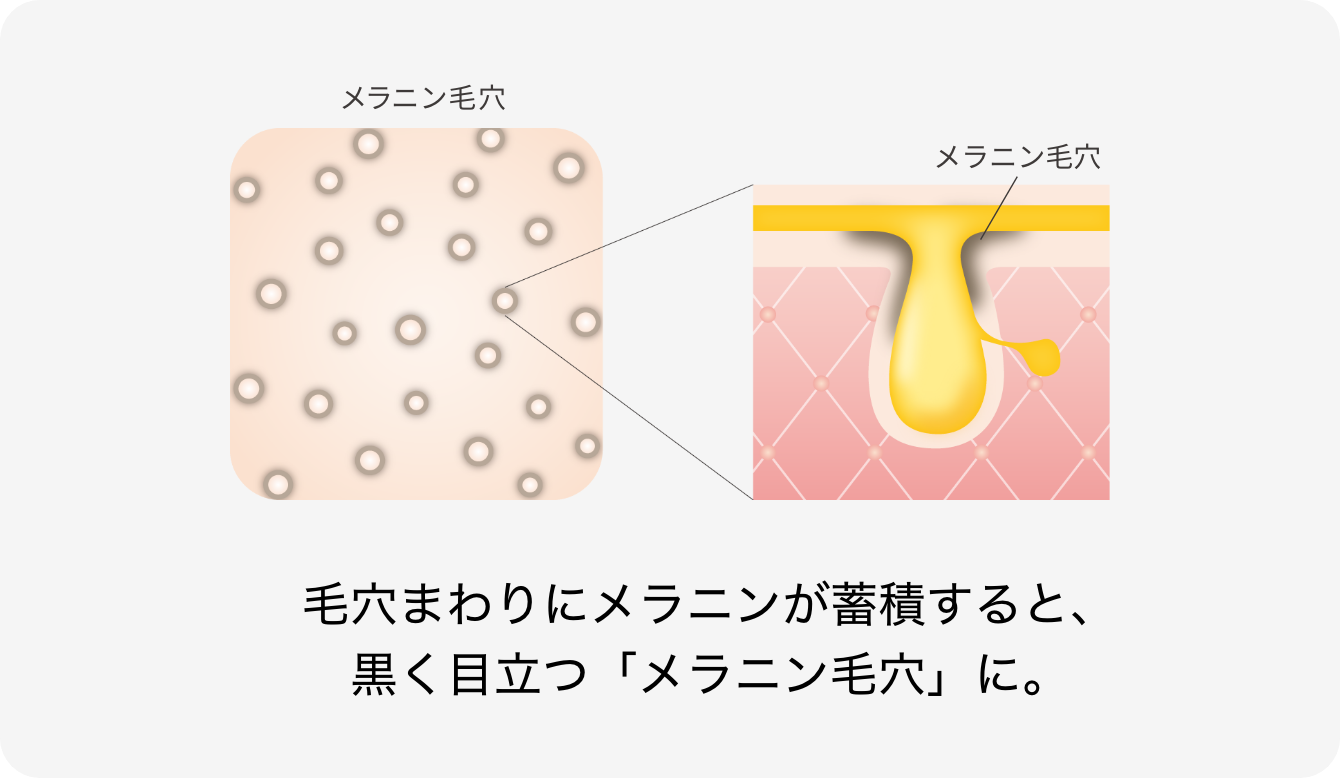 毛穴まわりにメラニンが蓄積すると、黒く目立つ「メラニン毛穴」に