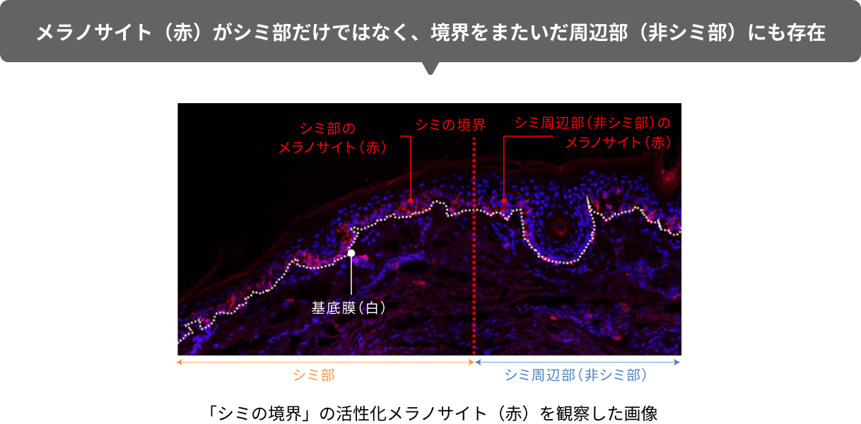 メラノサイト（赤）がシミ部だけではなく、境界をまたいだ周辺部（非シミ部）にも存在