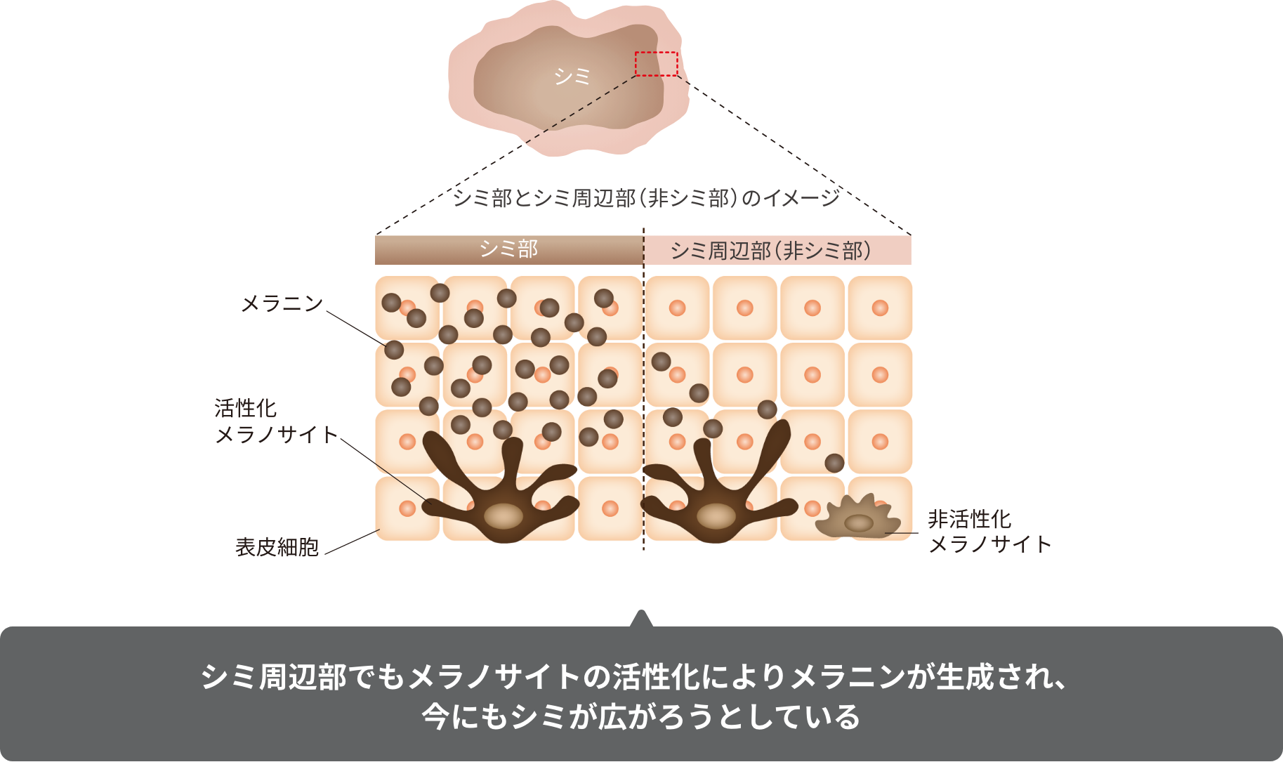 シミ周辺部でもメラノサイトの活性化によりメラニンが生成され、今にもシミが広がろうとしている