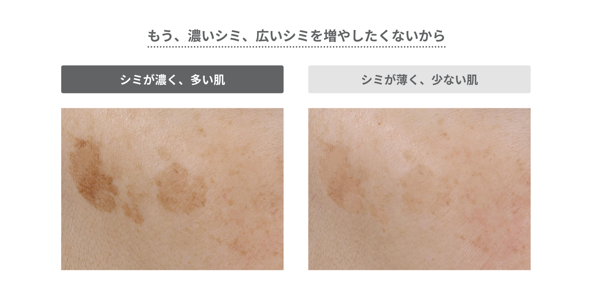 もう、濃いシミ、広いシミを増やしたくないから