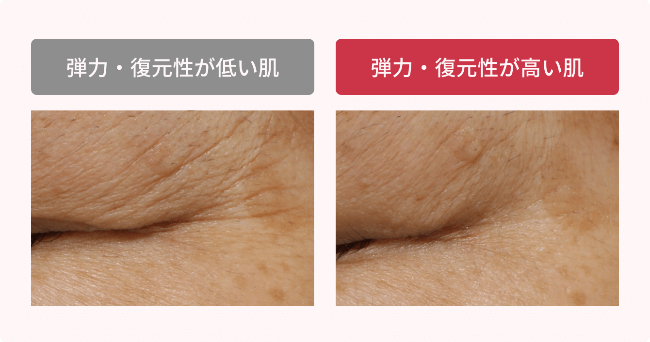 弾力・復元性が低い肌 弾力・復元性が高い肌