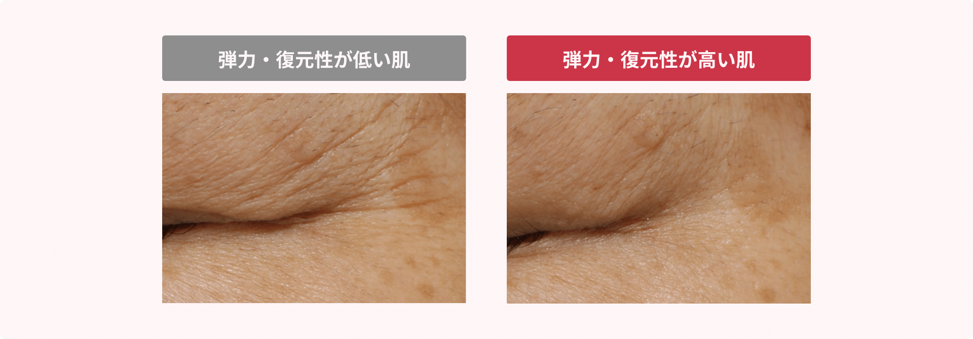 弾力・復元性が低い肌 弾力・復元性が高い肌