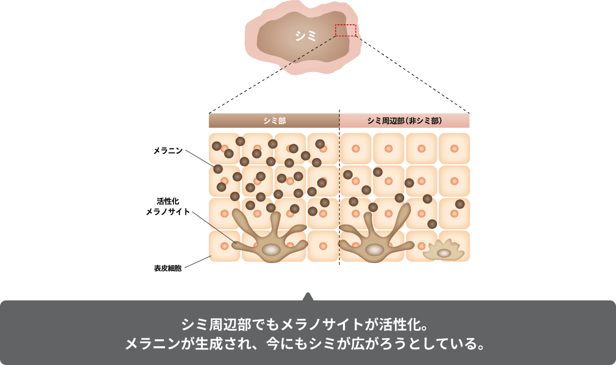 シミ周辺部でもメラノサイトが活性化。メラニンが生成され、今にもシミが広がろうとしている。