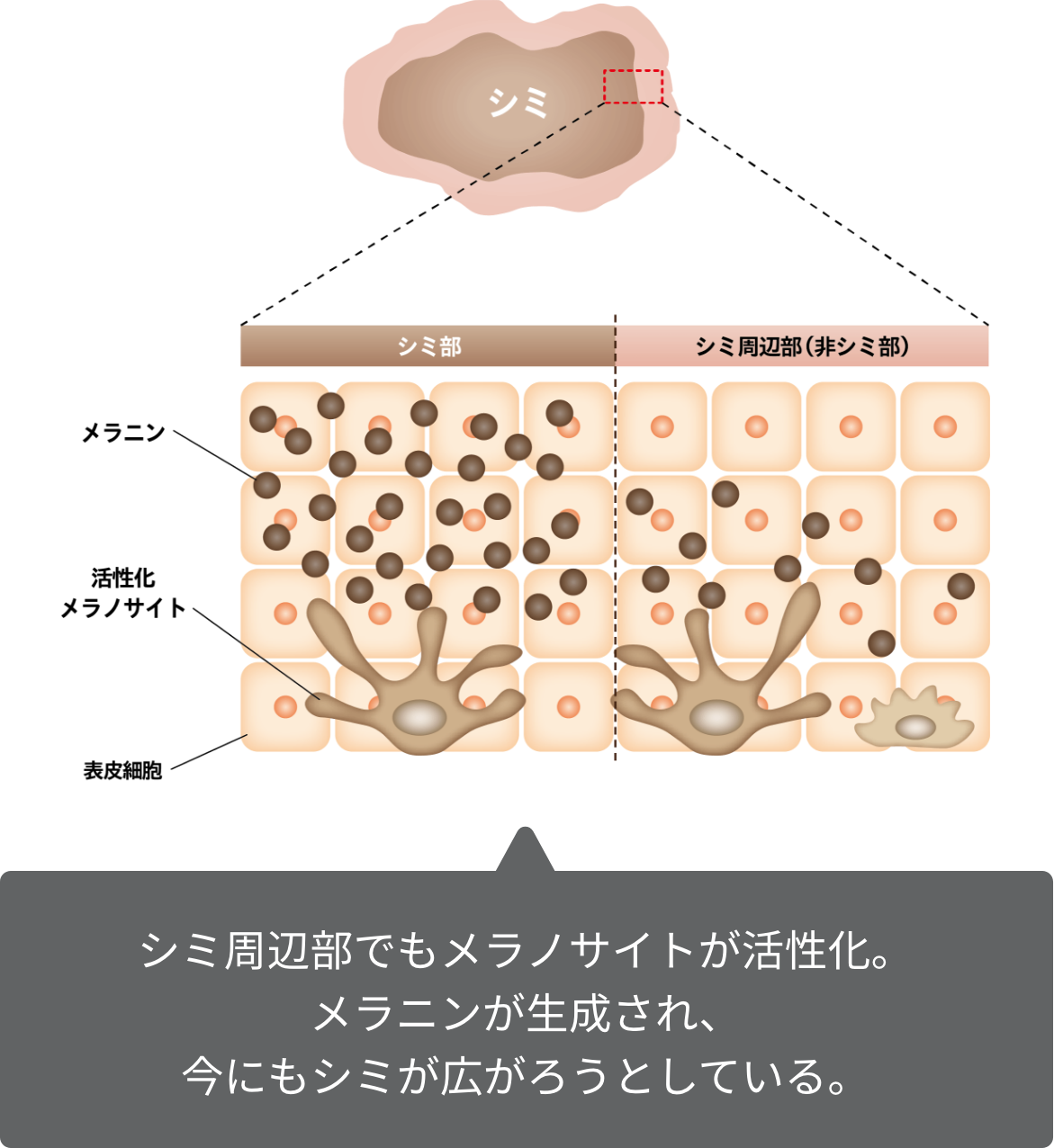 シミ周辺部でもメラノサイトが活性化。メラニンが生成され、今にもシミが広がろうとしている。
