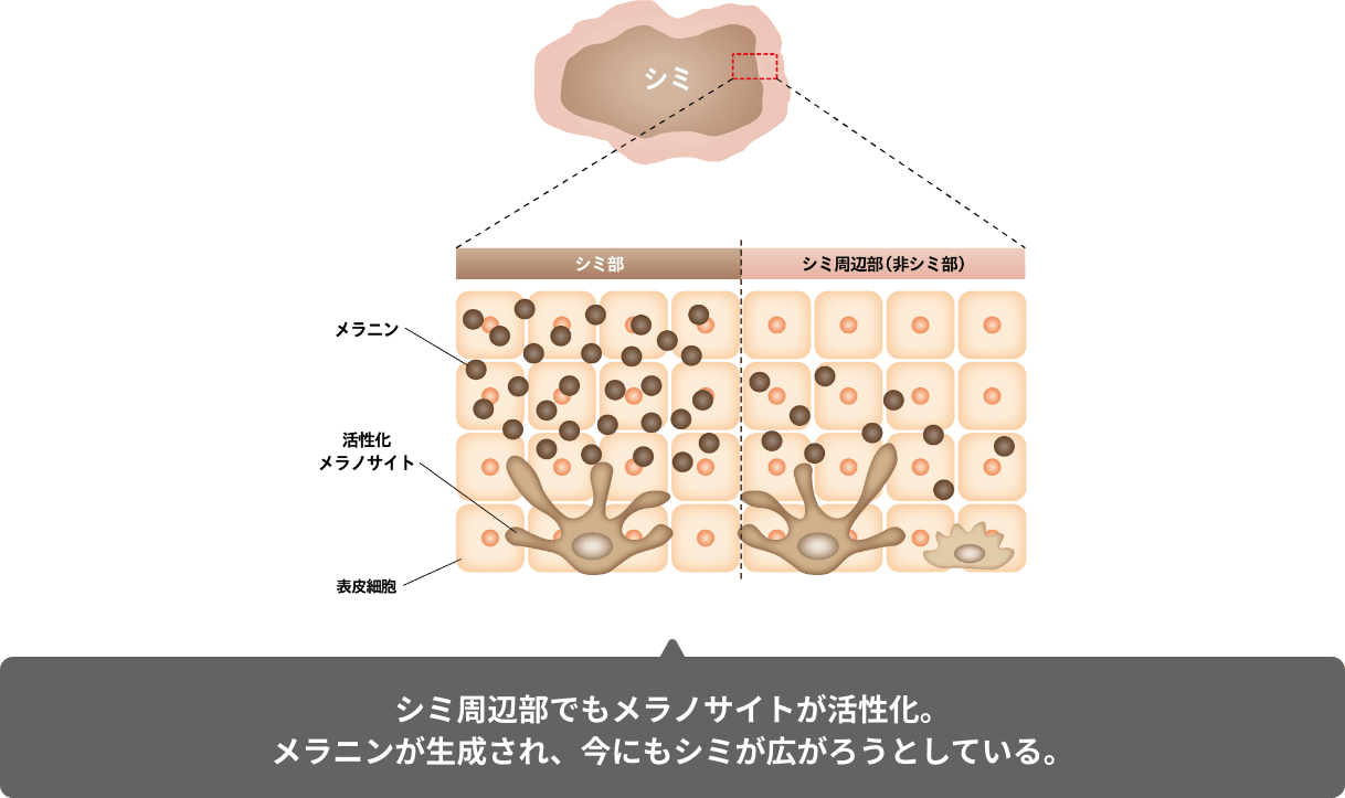 シミ周辺部でもメラノサイトが活性化。メラニンが生成され、今にもシミが広がろうとしている。