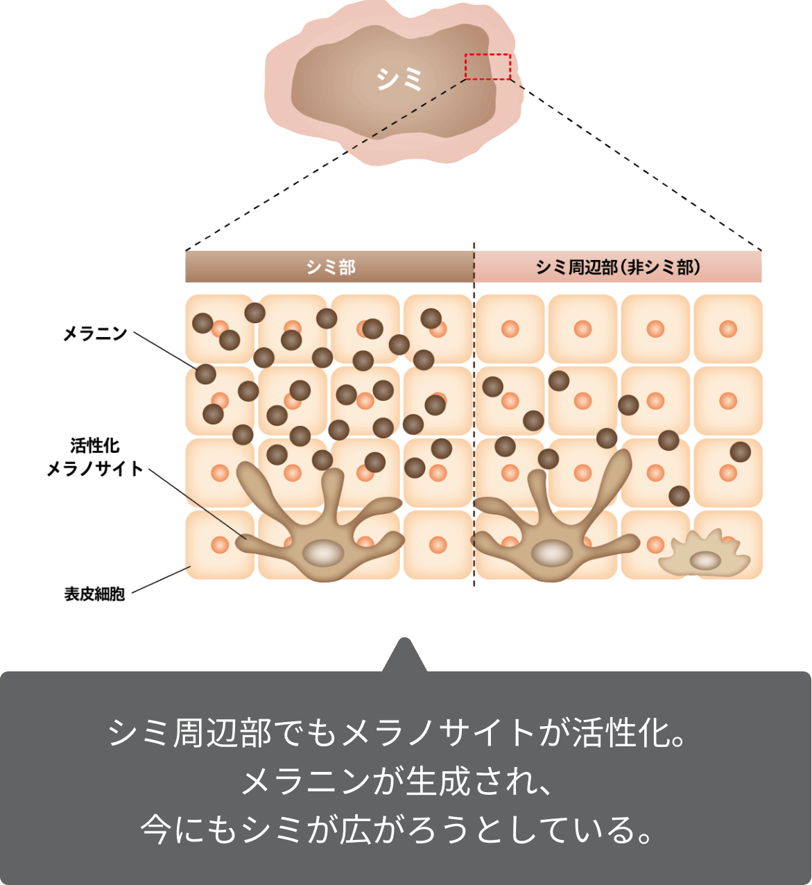 シミ周辺部でもメラノサイトが活性化。メラニンが生成され、今にもシミが広がろうとしている。