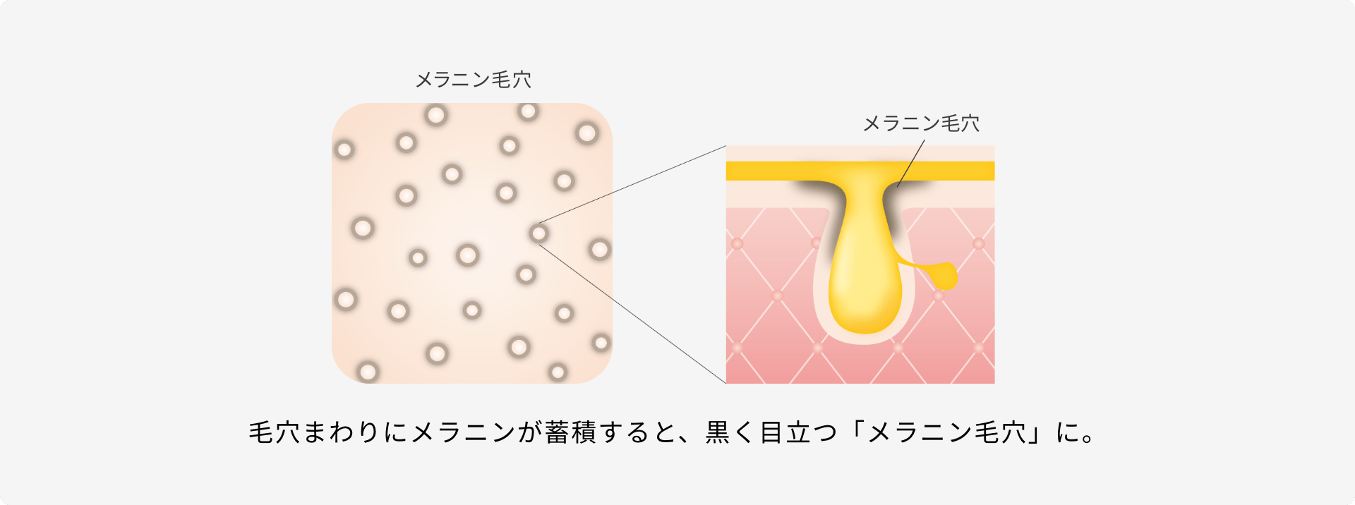 毛穴まわりにメラニンが蓄積すると、黒く目立つ「メラニン毛穴」に