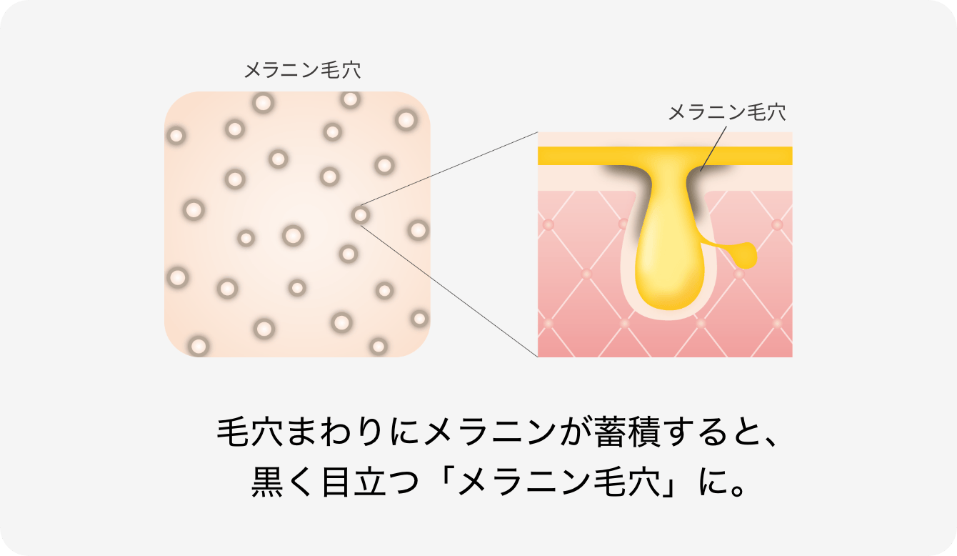 毛穴まわりにメラニンが蓄積すると、黒く目立つ「メラニン毛穴」に